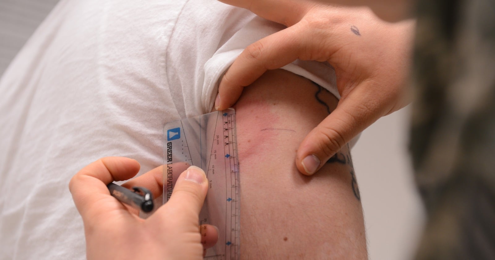 Why looking away during a skin prick may carry a physical cost — in one pre-registered experiment the welt at its peak averaged 3.5 mm when people kept their attention on their own arm and 5.0 mm when they watched video clips